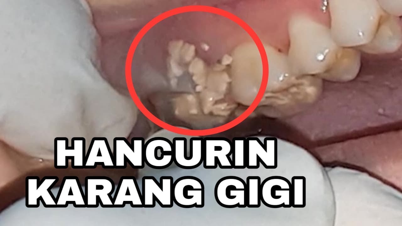 Detail Contoh Karang Gigi Nomer 10