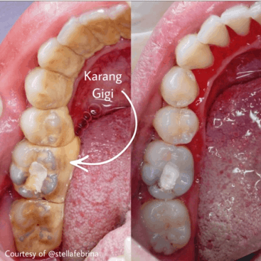 Detail Contoh Karang Gigi Nomer 41