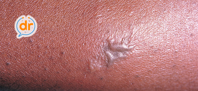 Detail Gambar Infeksi Jamur Nomer 25