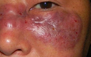 Detail Gambar Infeksi Jamur Nomer 28
