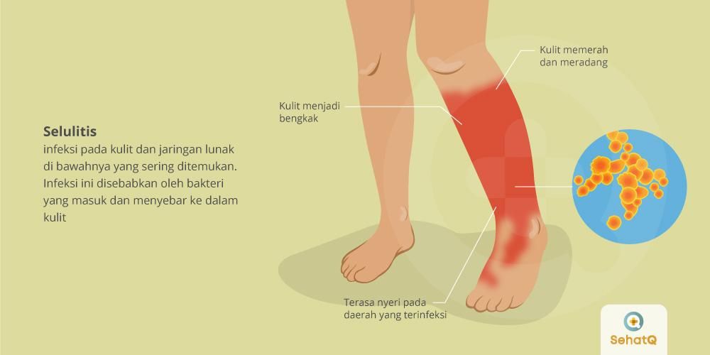 Detail Gambar Infeksi Kulit Nomer 28