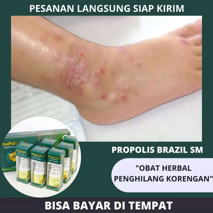 Detail Gambar Infeksi Kulit Nomer 58