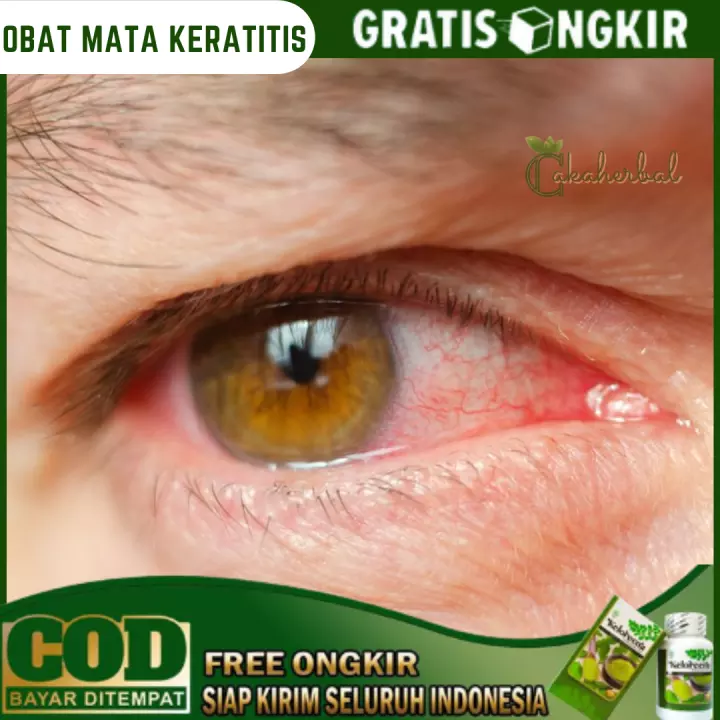 Detail Gambar Infeksi Mata Nomer 52