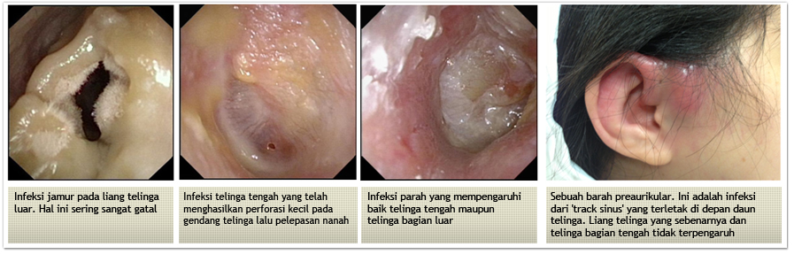 Detail Gambar Infeksi Telinga Nomer 4