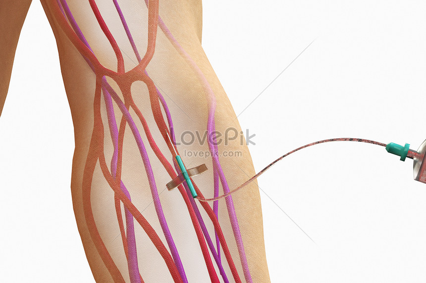 Detail Gambar Injeksi Intravena Nomer 11