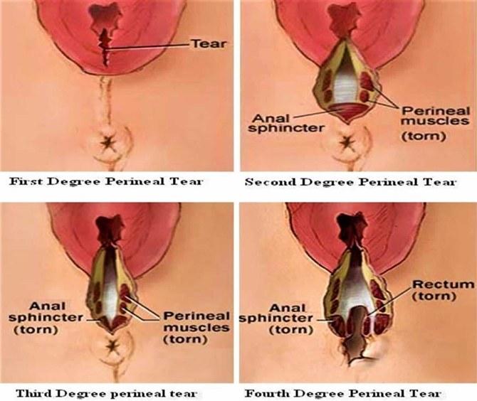 Detail Gambar Jahitan Melahirkan Normal Nomer 53