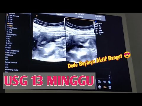 Detail Gambar Janin 10 Minggu Di Usg Nomer 51