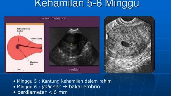 Detail Gambar Janin 6 Minggu Nomer 5