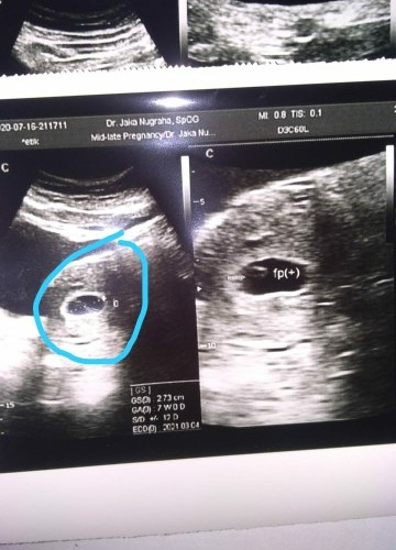 Detail Gambar Janin Usia 7 Minggu Nomer 32
