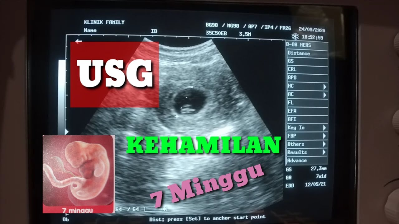 Detail Gambar Janin Usia 7 Minggu Nomer 9