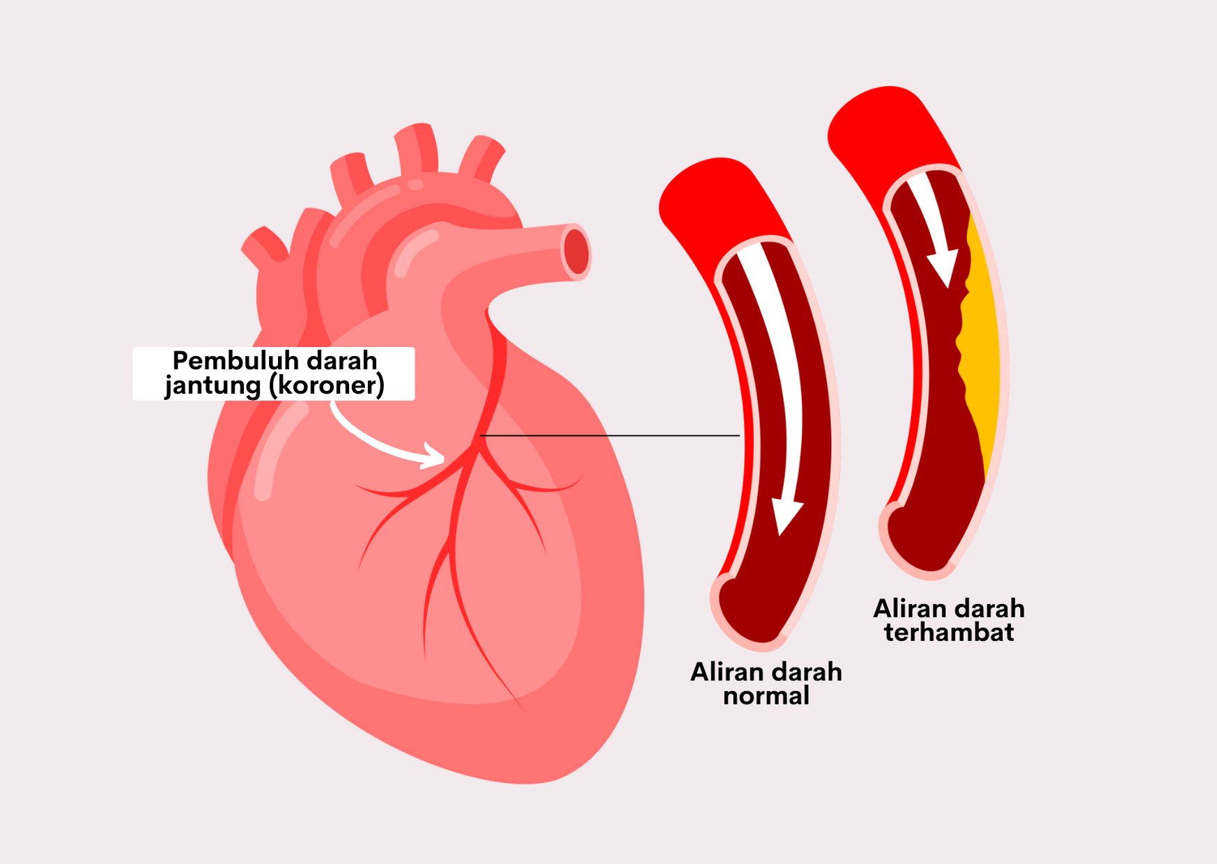 Detail Gambar Jantung Koroner Nomer 2