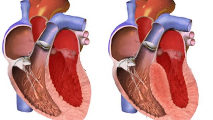 Detail Gambar Jantung Normal Nomer 10