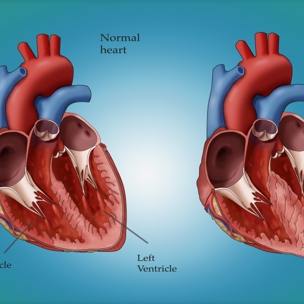Detail Gambar Jantung Normal Nomer 4