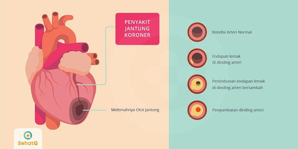 Detail Gambar Jantung Yang Mengalami Penyakir Jantung Koroneer Nomer 2