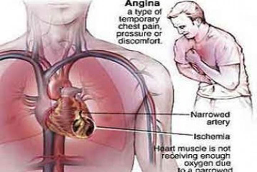 Detail Gambar Jantung Yang Mengalami Penyakir Jantung Koroneer Nomer 26