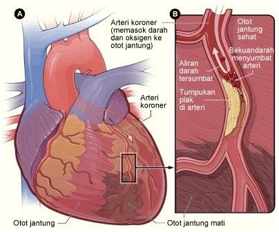 Detail Gambar Jantung Yang Mengalami Penyakir Jantung Koroneer Nomer 35