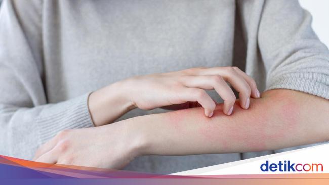 Detail Gambar Jenis Gatal Pada Jari Tangan Nomer 15