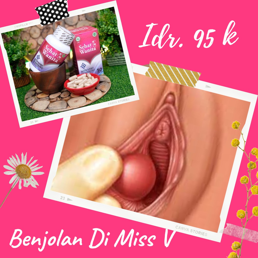 Detail Gambar Jerawat Di Miss V Nomer 34