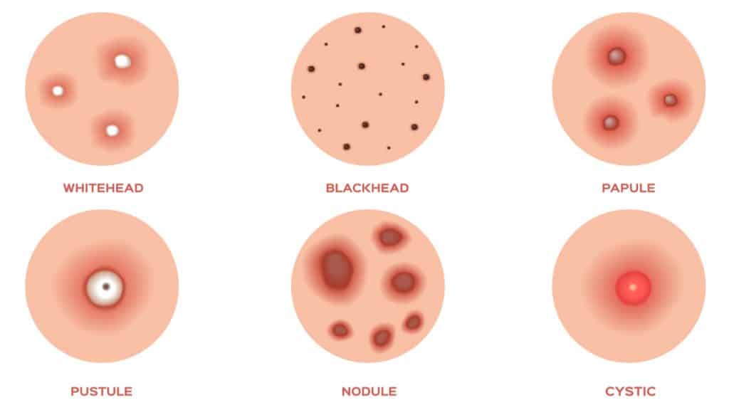 Detail Gambar Jerawat Pustula Nomer 19