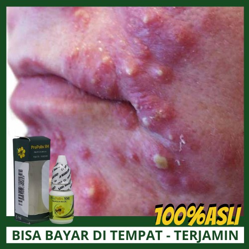 Detail Gambar Jerawat Pustula Nomer 50