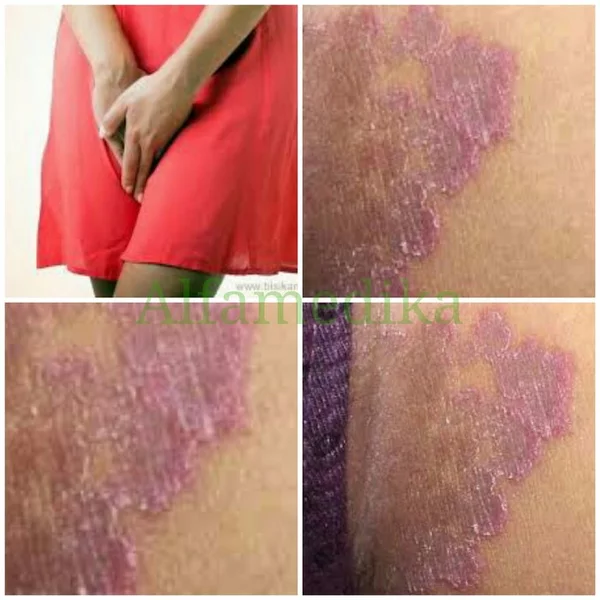 Detail Gambar Kadas Kulit Nomer 29