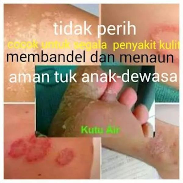 Detail Gambar Kadas Kulit Nomer 45