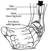 Detail Gambar Kaki Keseleo Nomer 42