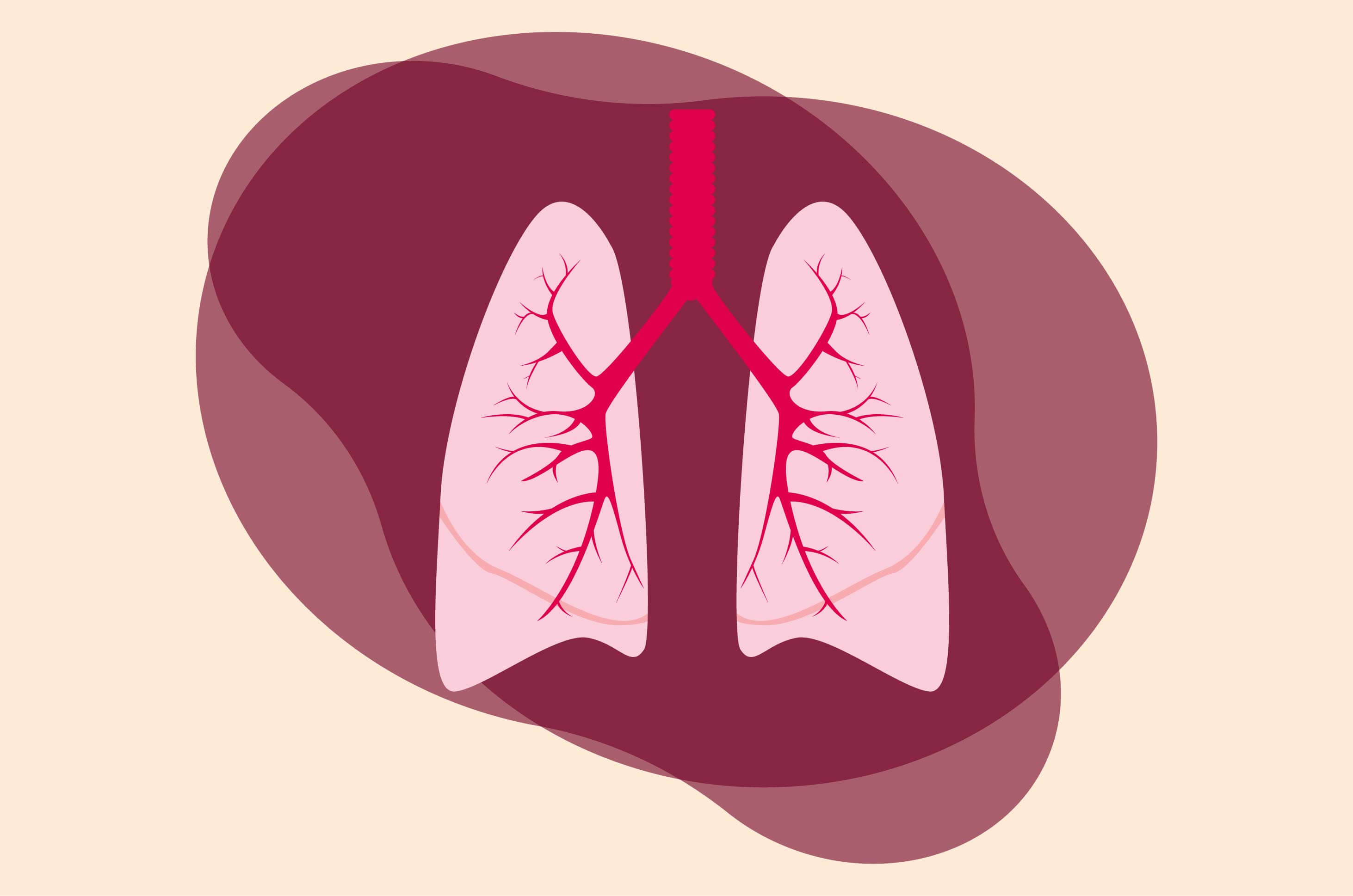 Detail Contoh Kasus Pneumonia Nomer 29