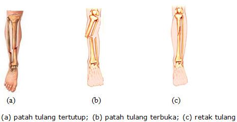 Detail Contoh Kelainan Tulang Nomer 46