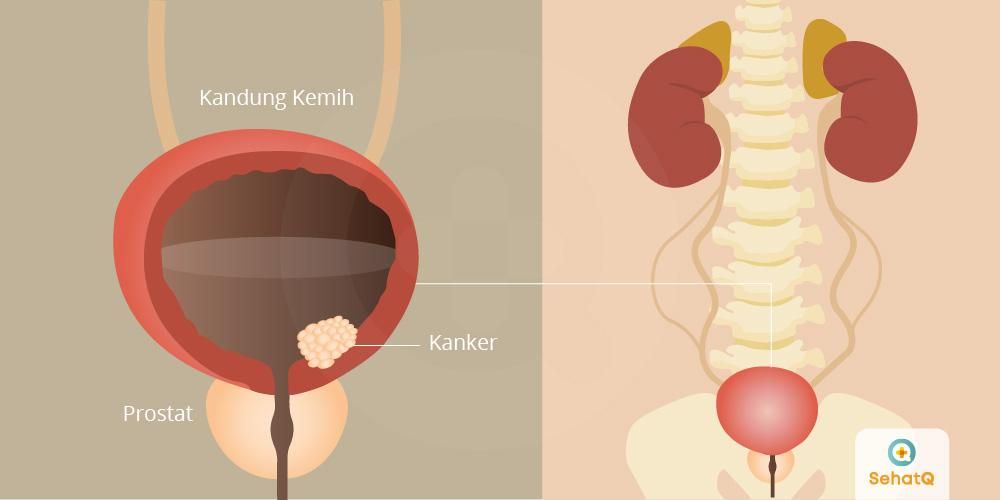 Detail Gambar Kandung Kemih Nomer 14