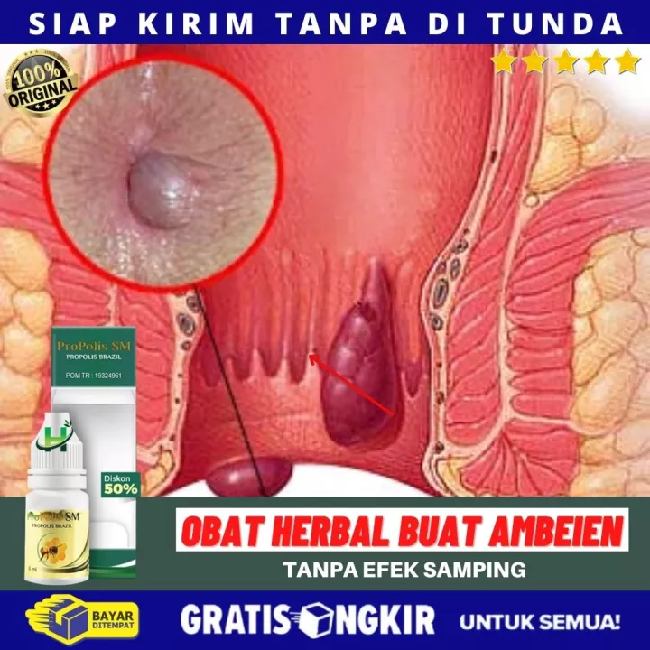 Detail Gambar Kanker Dubur Nomer 48