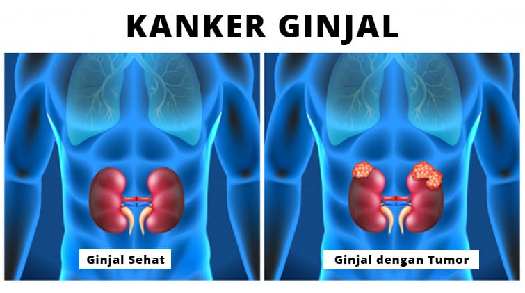 Detail Gambar Kanker Ginjal Nomer 9