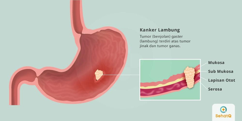 Gambar Kanker Lambung - KibrisPDR