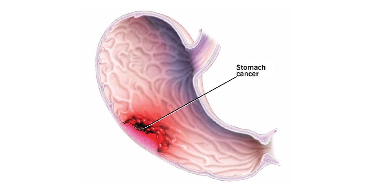 Detail Gambar Kanker Lambung Nomer 13