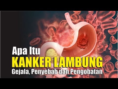 Detail Gambar Kanker Lambung Nomer 49