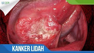 Detail Gambar Kanker Lidah Nomer 15