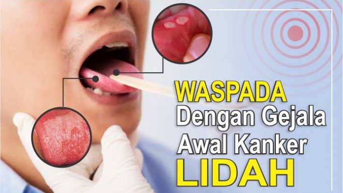 Detail Gambar Kanker Lidah Nomer 26