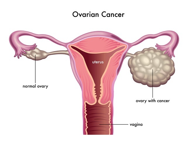 Detail Gambar Kanker Ovarium Nomer 2