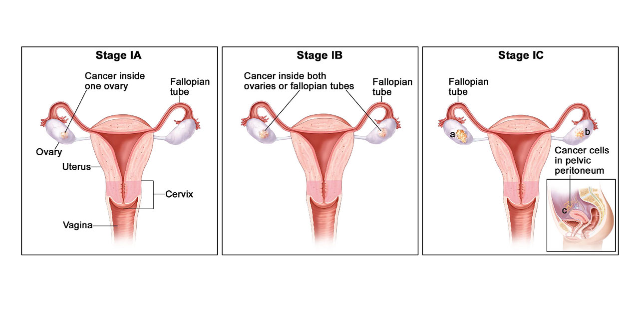 Detail Gambar Kanker Ovarium Nomer 16