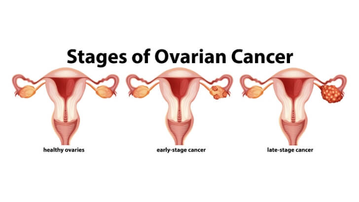 Detail Gambar Kanker Ovarium Nomer 50
