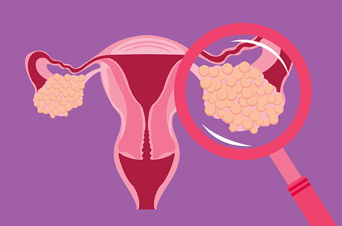 Detail Gambar Kanker Ovarium Nomer 6