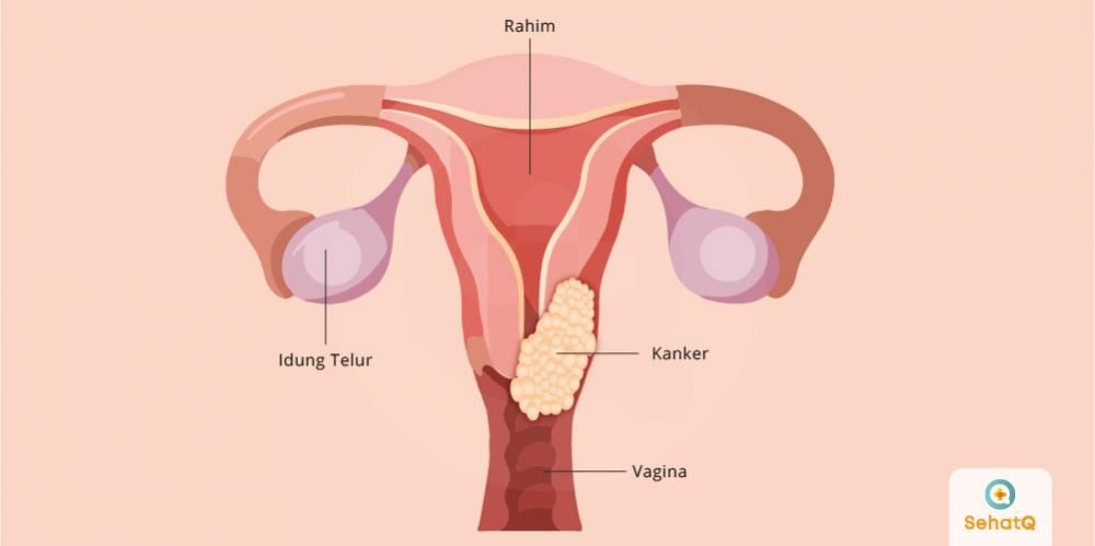 Detail Gambar Kanker Pada Pada Wanita Nomer 17