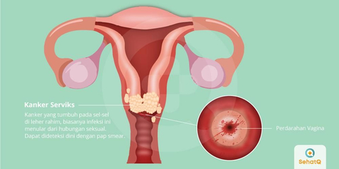 Detail Gambar Kanker Pada Pada Wanita Nomer 5