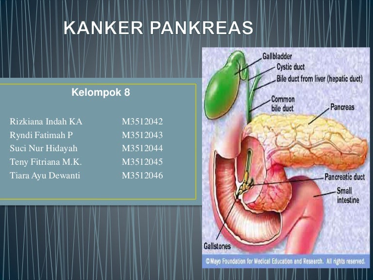 Detail Gambar Kanker Pankreas Nomer 10