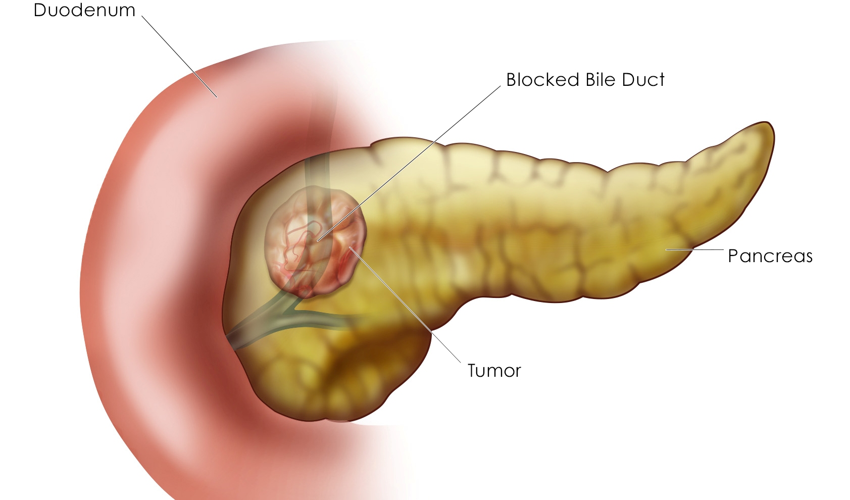 Detail Gambar Kanker Pankreas Nomer 16
