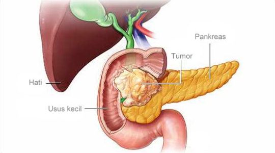 Detail Gambar Kanker Pankreas Nomer 25