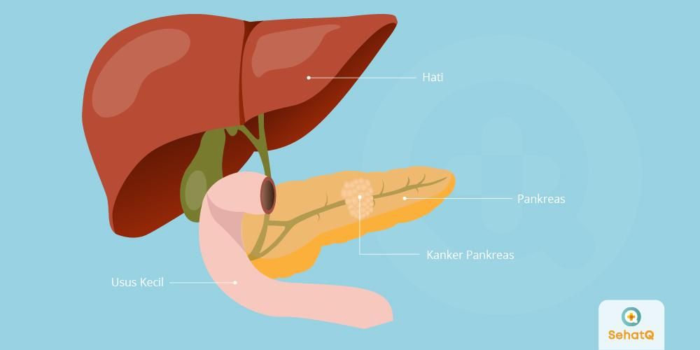 Detail Gambar Kanker Pankreas Nomer 29