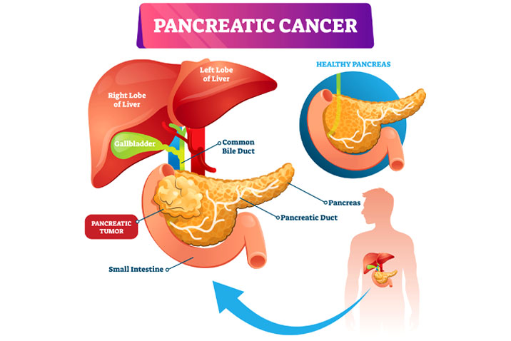 Detail Gambar Kanker Pankreas Nomer 5