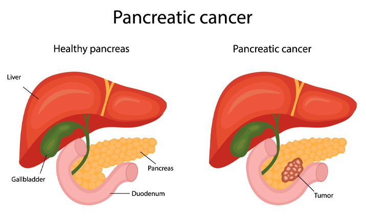 Detail Gambar Kanker Pankreas Nomer 8