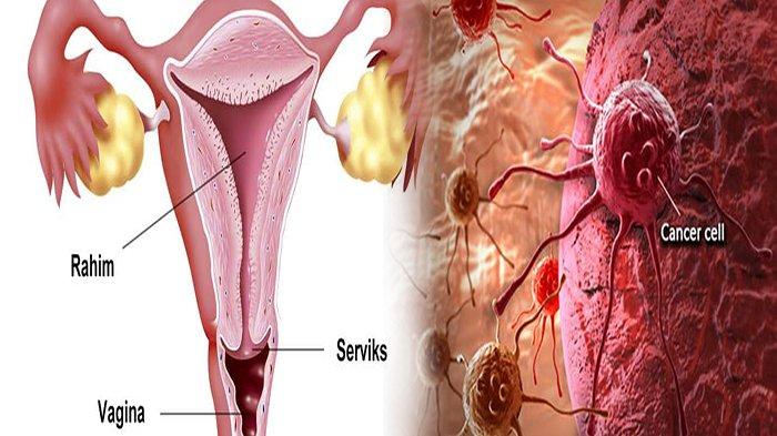 Detail Gambar Kanker Rahim Nomer 23
